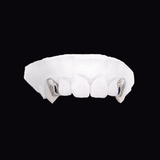 ICED London dental model of upper jaw with two metal crowns on canines, white plaster cast on black background.