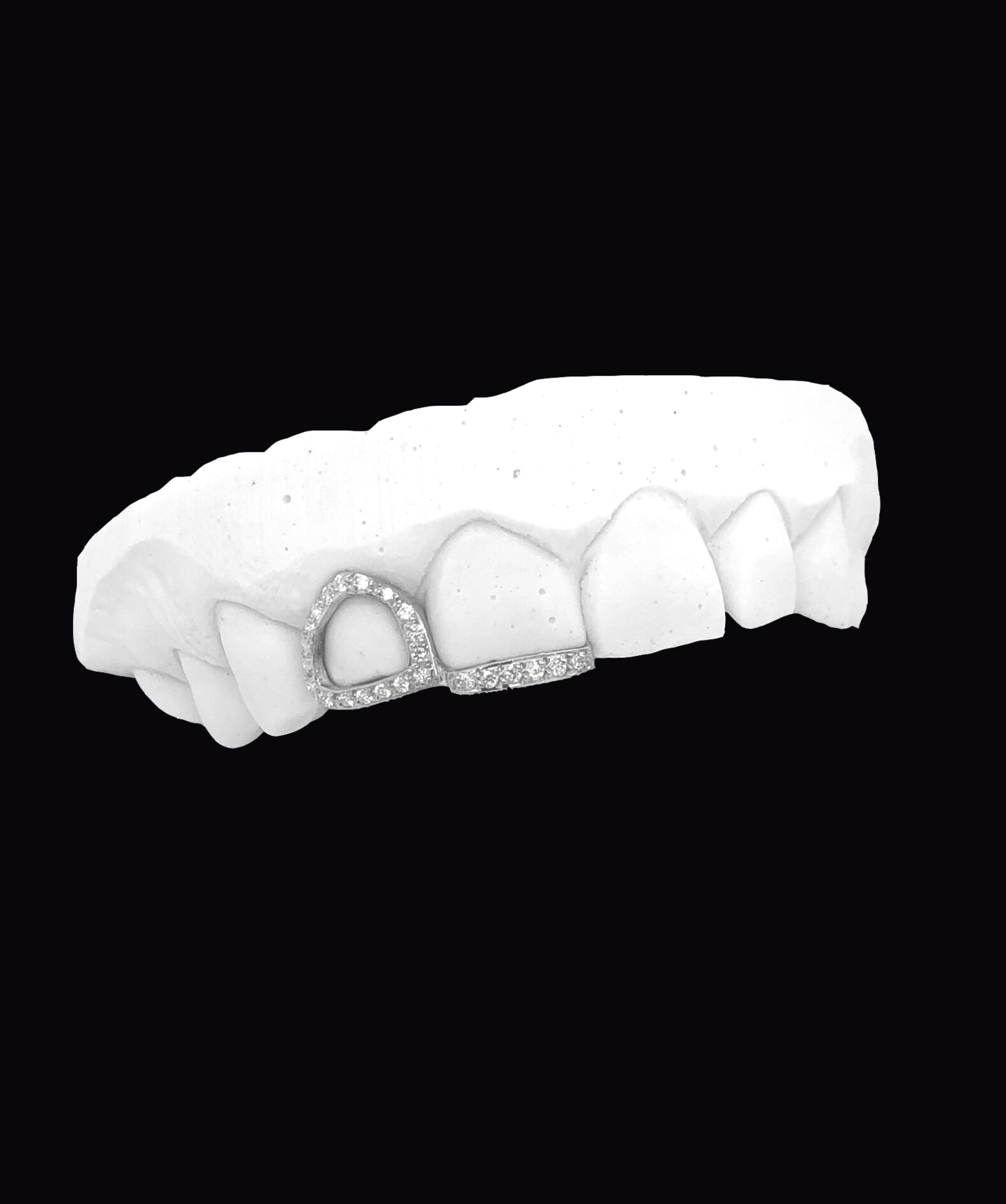 ICED London dental model showing upper teeth with a diamond-studded crown/restoration on the front tooth.