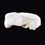 Dental model showing a gold crown on a front tooth, isolated on black background. ICED London.
