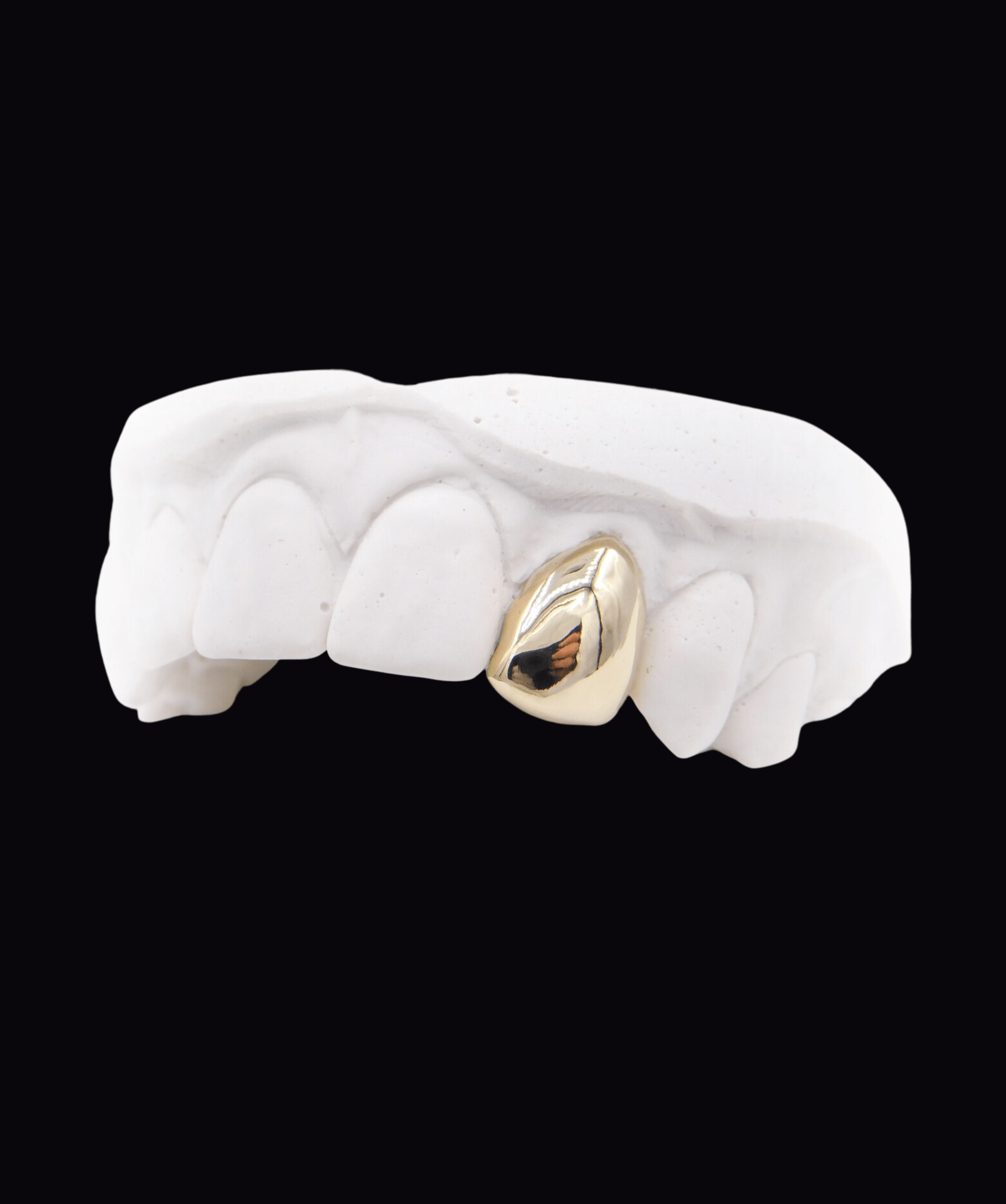 Dental model showing a gold crown on a front tooth, isolated on black background. ICED London.