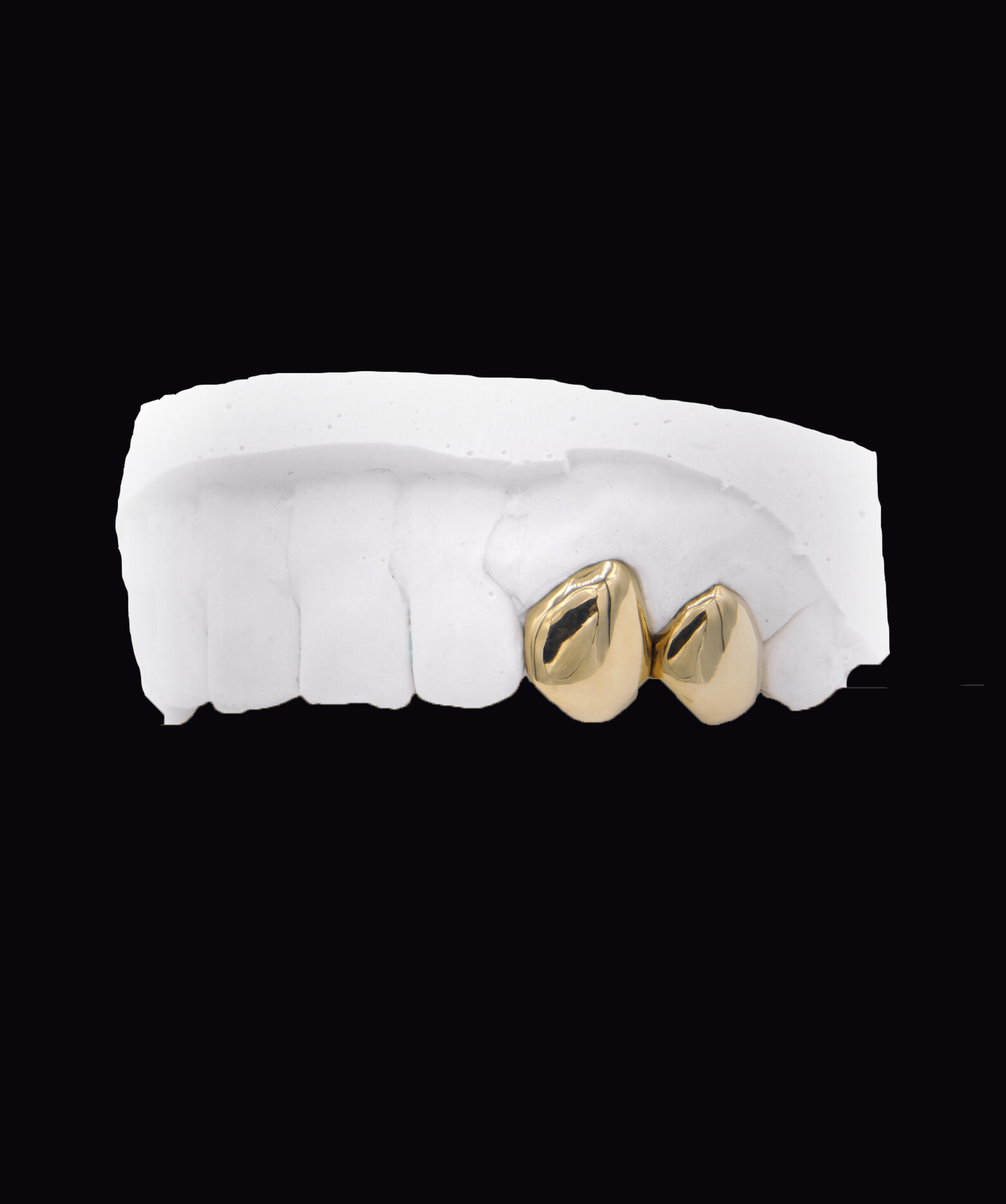 Dental model featuring two gold crowns on front teeth (cosmetic dentistry), ICED London.