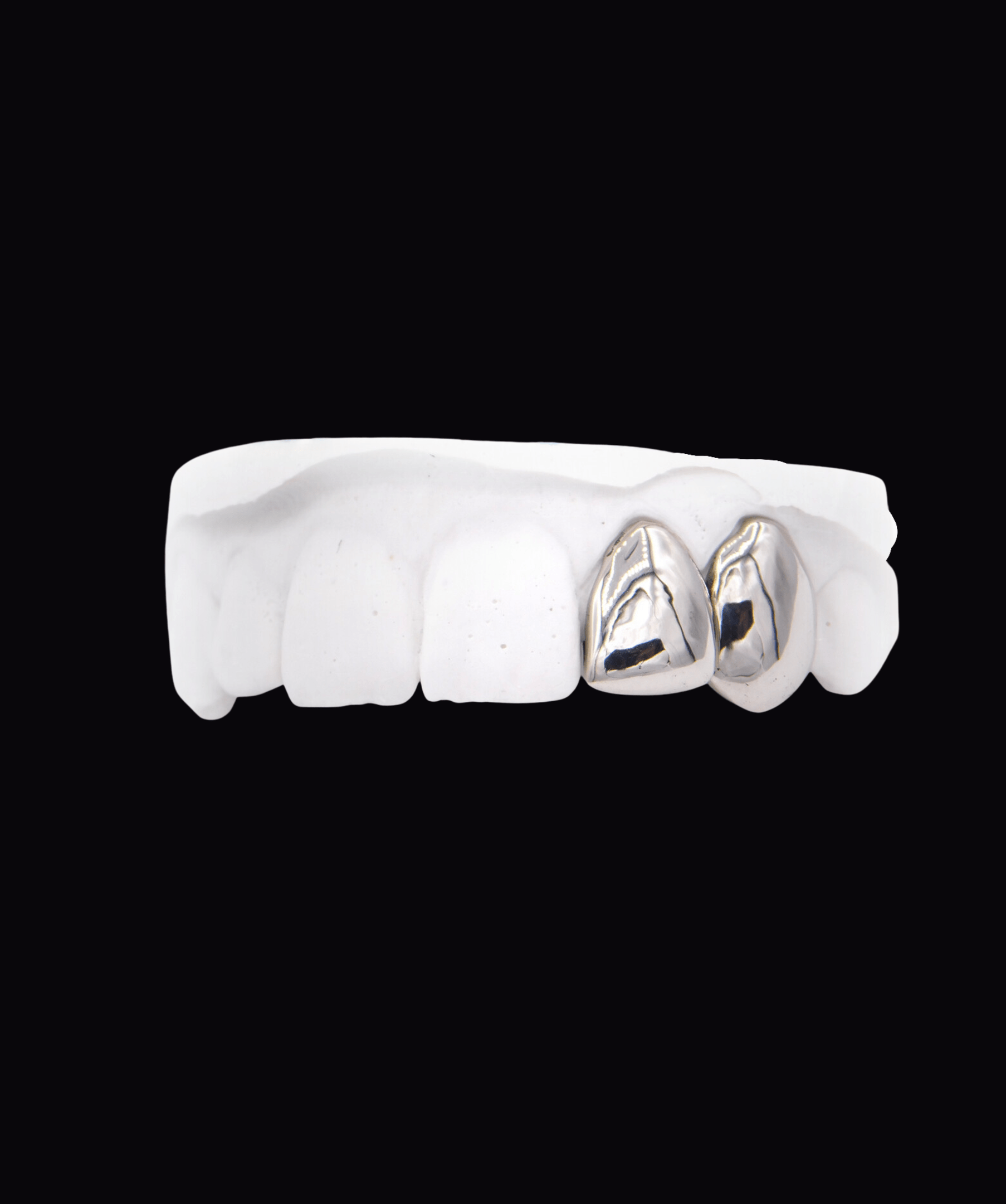 ICED London dental model showing two metallic crowns on the front teeth against a black background.