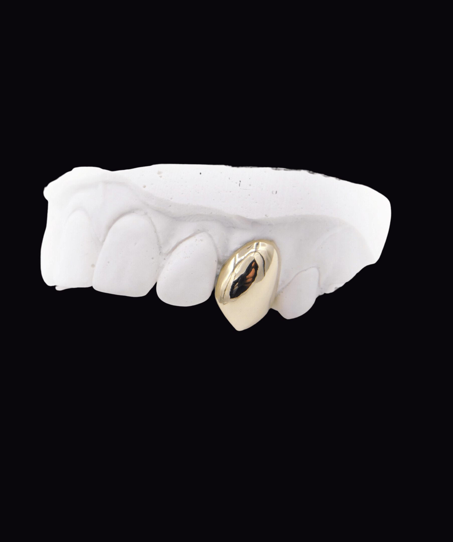Dental plaster model showing a gold dental crown on a tooth, isolated on a black background. ICED London.
