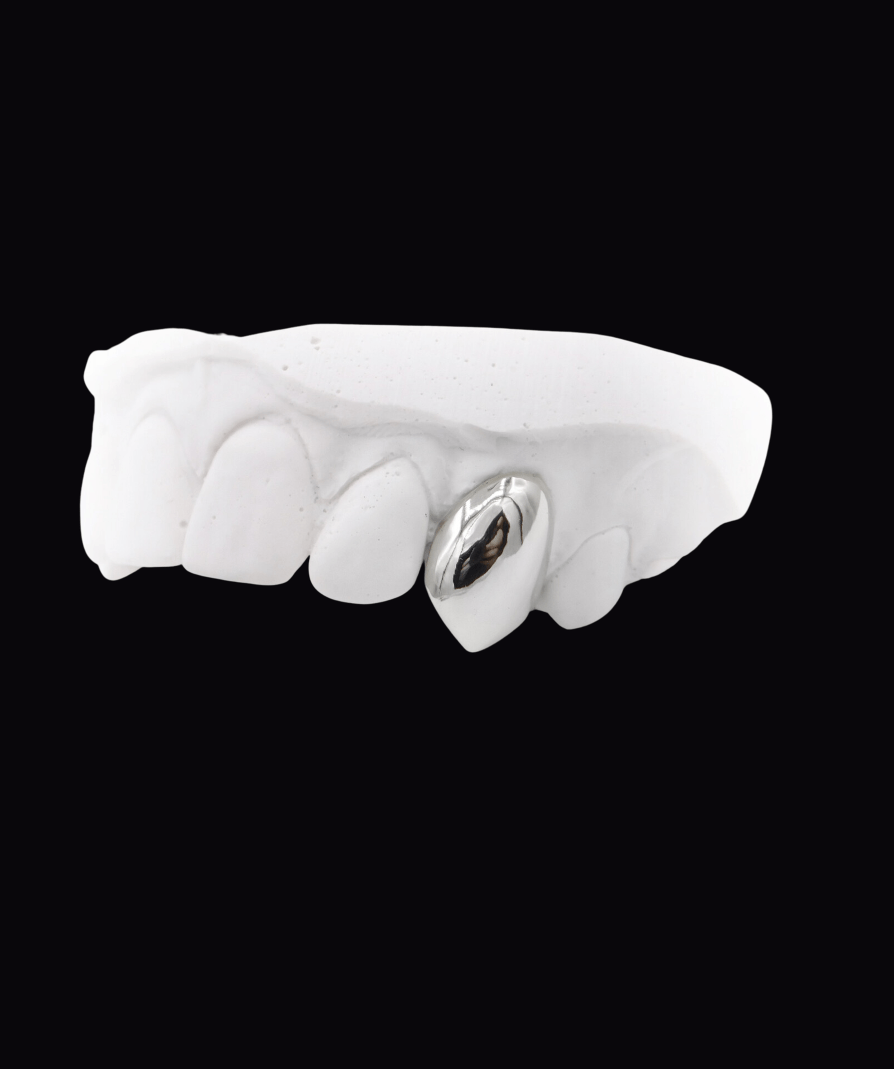 ICED London dental model with a metallic crown on one front tooth among white teeth, on a black background.