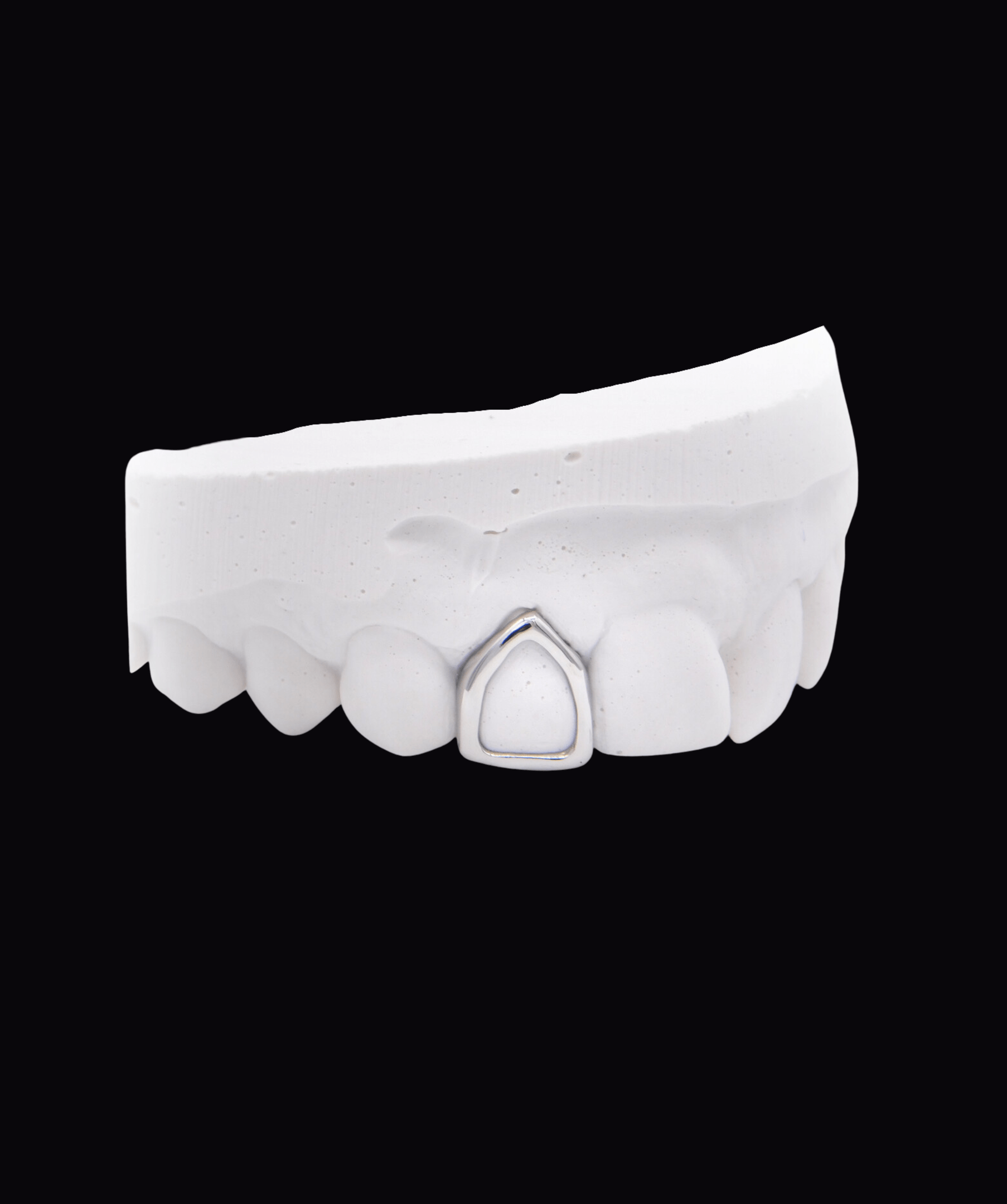 Dental model showing a front tooth with a silver dental crown/implant crown (ICED London).