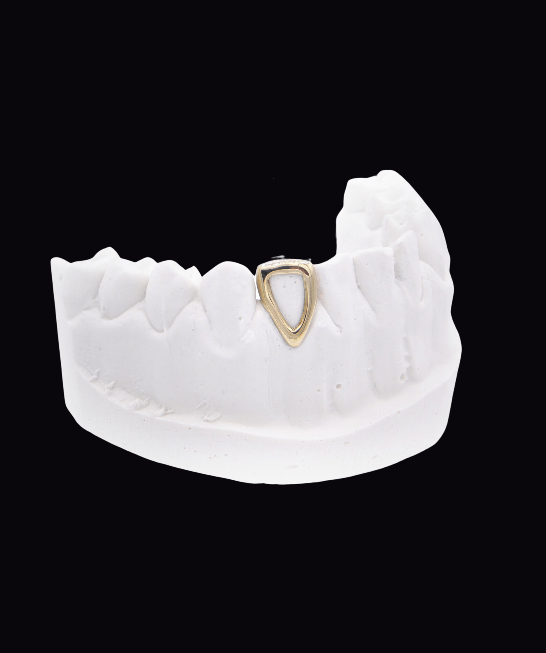 ICED London: gold triangular dental implant accessory attached to a white dental model (side view).
