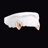 ICED London dental model showing two gold crowns on molars on a white plaster arch against a black background.