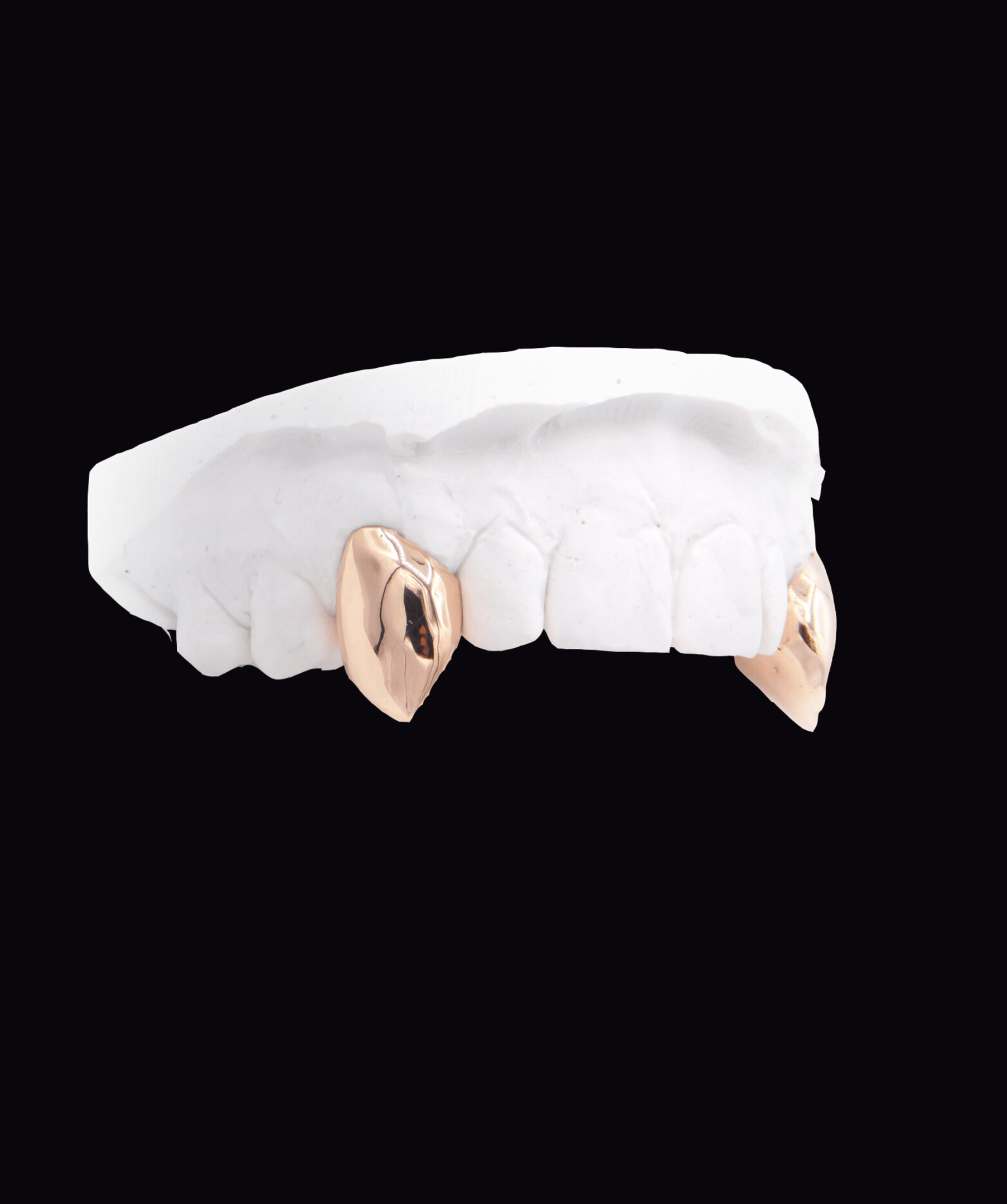 ICED London dental model showing two gold crowns on molars on a white plaster arch against a black background.