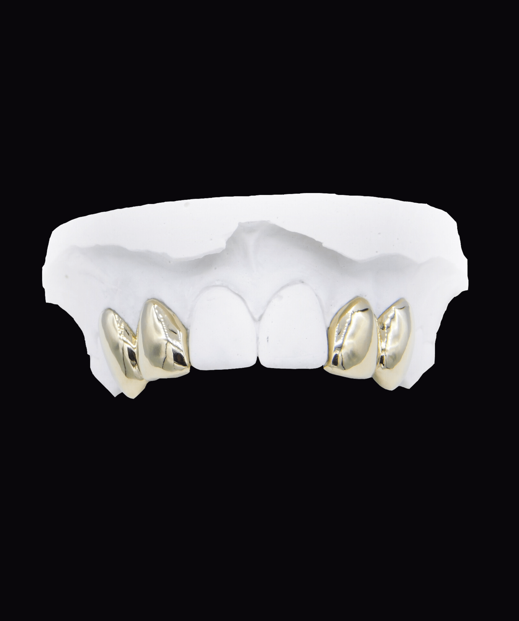Upper dental model featuring gold crowns on the side incisors, white plaster arches, ICED London.